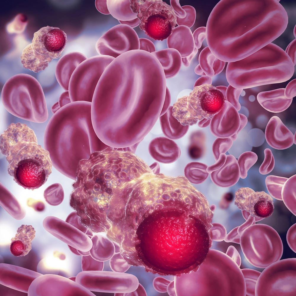 クローン性造血の臨床予後への影響を解明