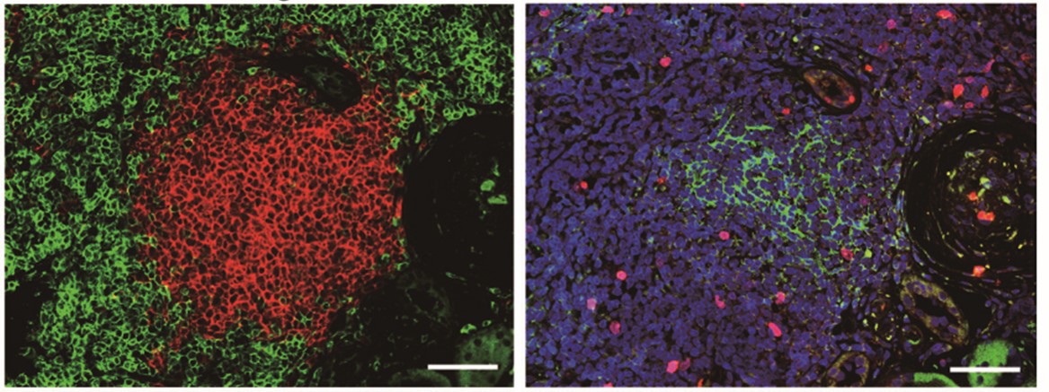 Immunoﬂuorescence analysis of kidney allograft tissues showing stage II tertiary lymphoid tissues. (Left) Red indicates CD20-positive B cells, green indicates CD3-positive T cell markers. (Right) Red indicates Ki67-positive proliferating cells, green indicates CD21-positive follicular dendritic cells.